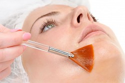 Chemical peels
