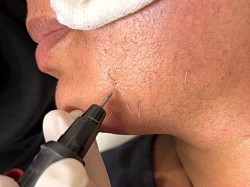 Permanent hair removal