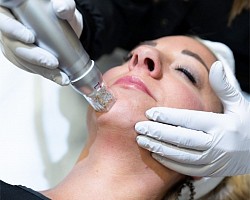 MNRF face rejuvenation