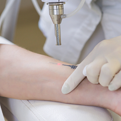 Laser tattoo removal