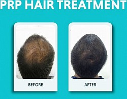PRP Hair Treatment