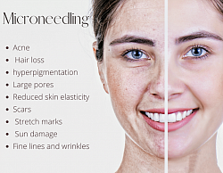 Microneedling