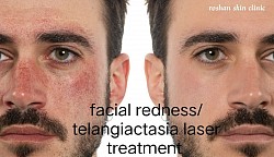 Facial redness removal