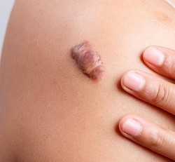 Scar treatment