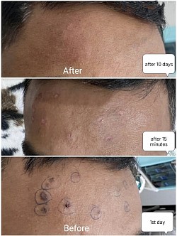 Flat warts removed