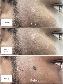 Mole removal before and after