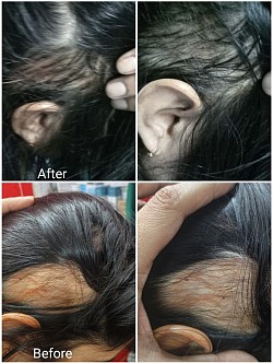Patchy hairloss before and after