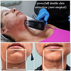 Double Chin removal before and after