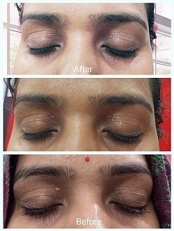 Xanthelasma removal