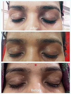 Xanthelasma removal