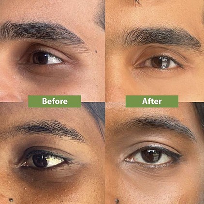 Dark circles clearance